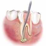 Endodonzia1