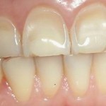erosione_dentale_denti_benessere