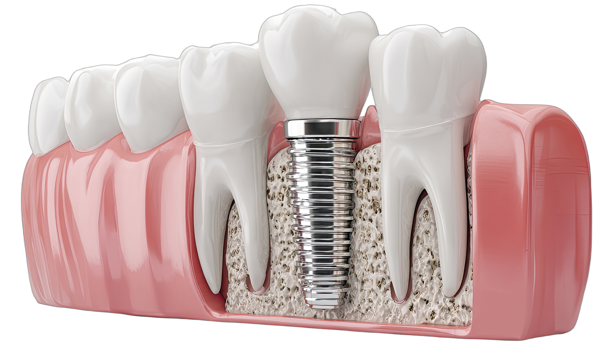 Impianti dentali: torna a sorridere e a masticare con sicurezza