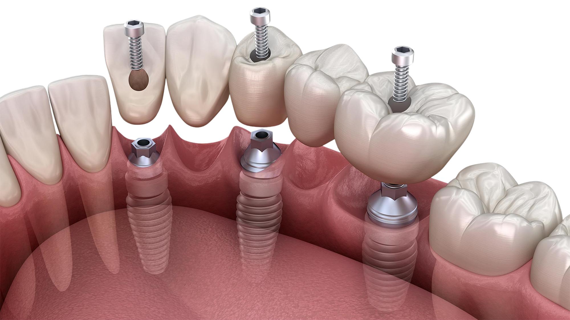 Impianti dentali: torna a sorridere e a masticare con sicurezza