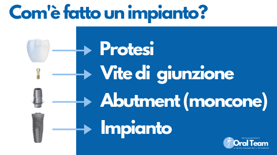 Implantologia Dr. Andrea Grassi Oral Team Agrate Brianza