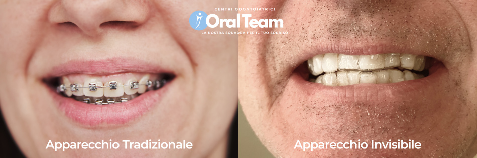 Apparecchio Invisibile vs Apparecchio Tradizionale | Centri Odontoiatrici Oral Team | Dentista Agrate Brianza - Dentista Macherio - Dentista Monza e Brianza