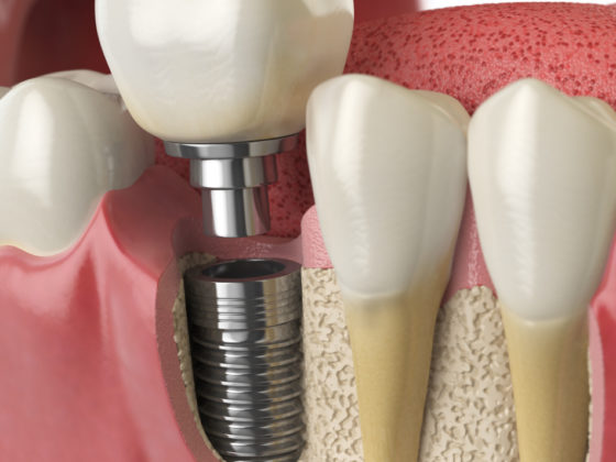 Dentista ed Implantologia Agrate Brianza Macherio - Centri Odontoiatrici Oral Team