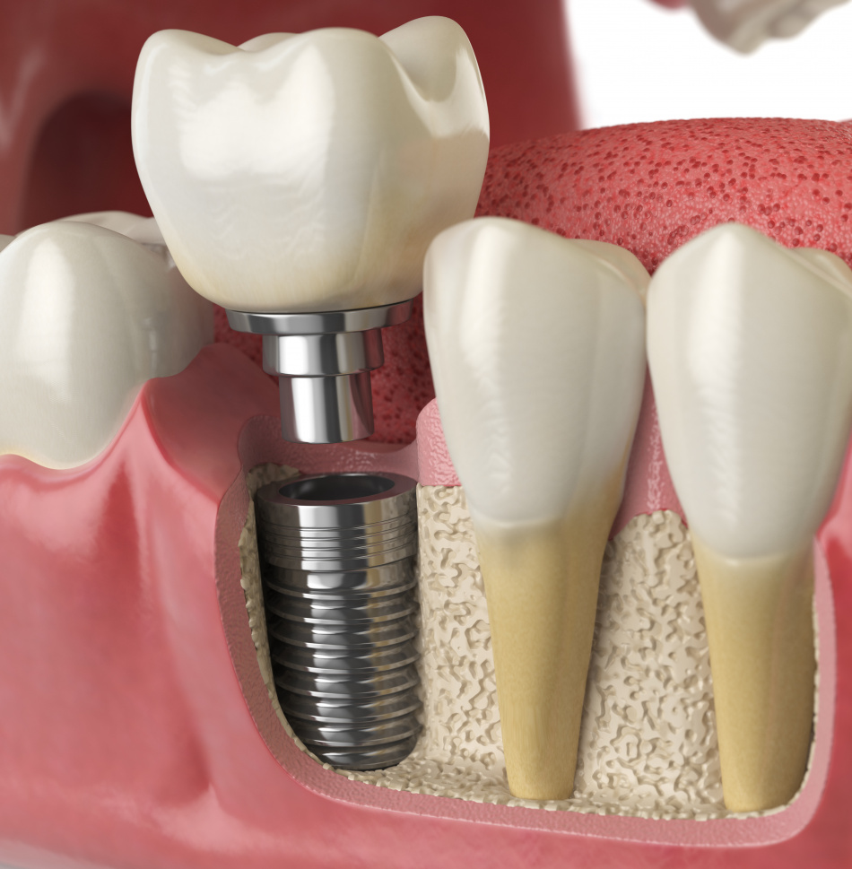 Dentista ed Implantologia Agrate Brianza Macherio - Centri Odontoiatrici Oral Team