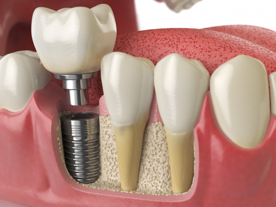 Com'è fatto un impianto dentale?