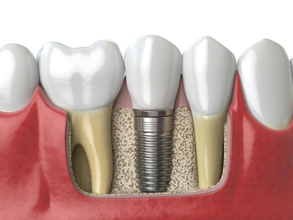 Attenzione: Nell'impianto dentale si vede la vite, che fare? Nell’impianto dentale si vede la vite, cosa fare?