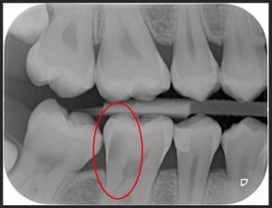 bite wing denti carie