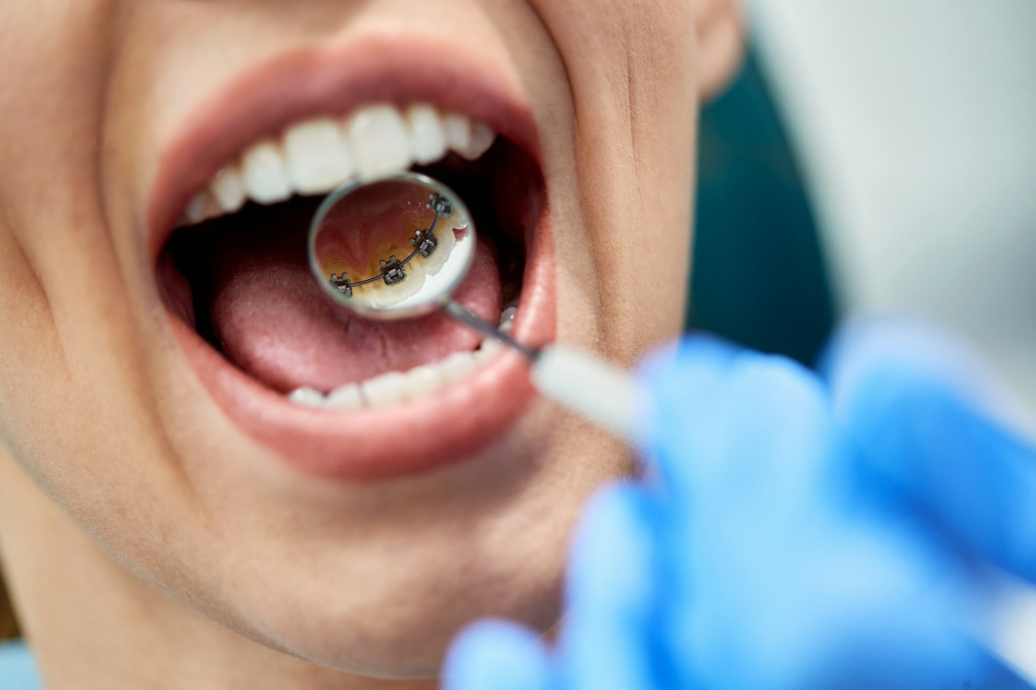 Apparecchio invisibile per denti - Apparecchio Linguale - Oral Team, Dentista Macherio, Dentista Agrate Brianza