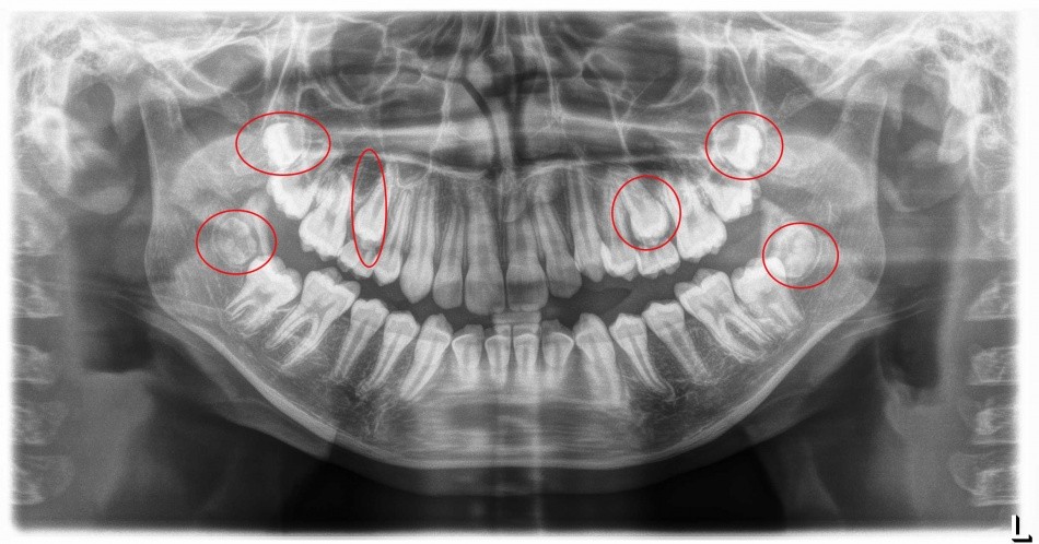 radiografia_bocca