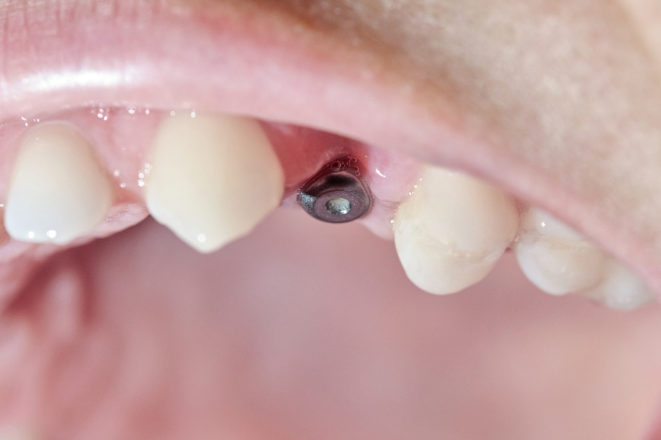 Attenzione! Impianto dentale gengiva ritirata: cosa fare? impianto dentale gengiva ritirata